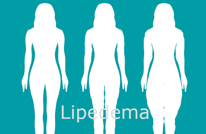 Lipedema rimedi