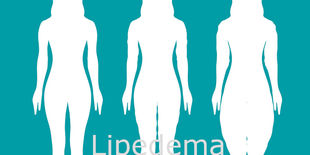 Lipedema: cos'è e guida ai migliori rimedi per contrastarlo
