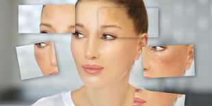 Macchie solari della pelle: come prevenirle e schiarirle con i prodotti giusti