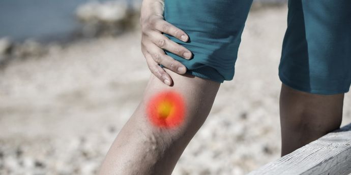 I migliori rimedi contro le vene varicose