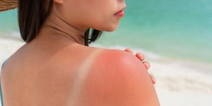 Le 5 migliori creme per scottature ed eritemi solari per un sollievo rapido ed efficace