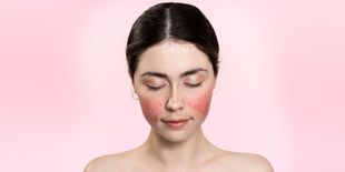 Rosacea: come riconoscerla e combatterla efficacemente