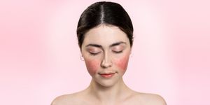 Rosacea o couperose: come combatterla