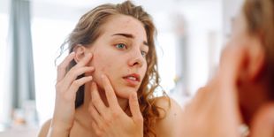 Acne e sole: benefici e controindicazioni