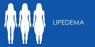 Lipedema: 5 rimedi per tenere sotto controllo i sintomi