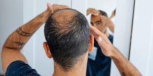 Calvizie nell’uomo: cos’è, cause e rimedi