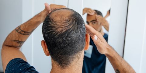 Uomo con stempiatura che osserva la propria testa calva allo specchio toccandosi i capelli.