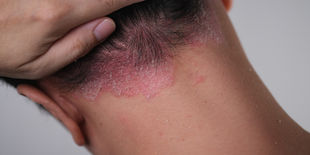I 5 prodotti per combattere la psoriasi del cuoio capelluto
