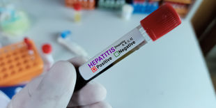 Provetta con etichetta di analisi medica per epatite tenuta da mano con guanto in laboratorio, sfondo sfocato di strumenti